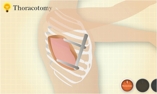 <span>單孔胸腔鏡手術動畫製作</span><i>→</i>